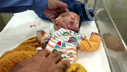 Birth of a two-faced baby at a government hospital in Jhelum